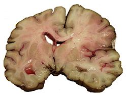 250px-MCA-Stroke-Brain-Human-2