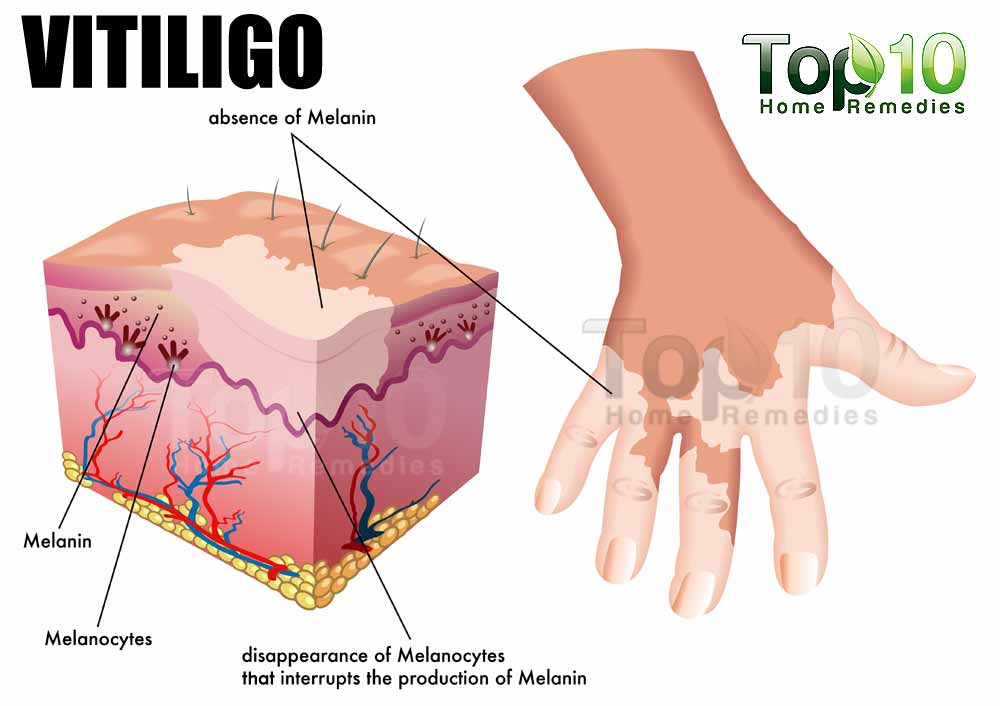 vitiligo-1000