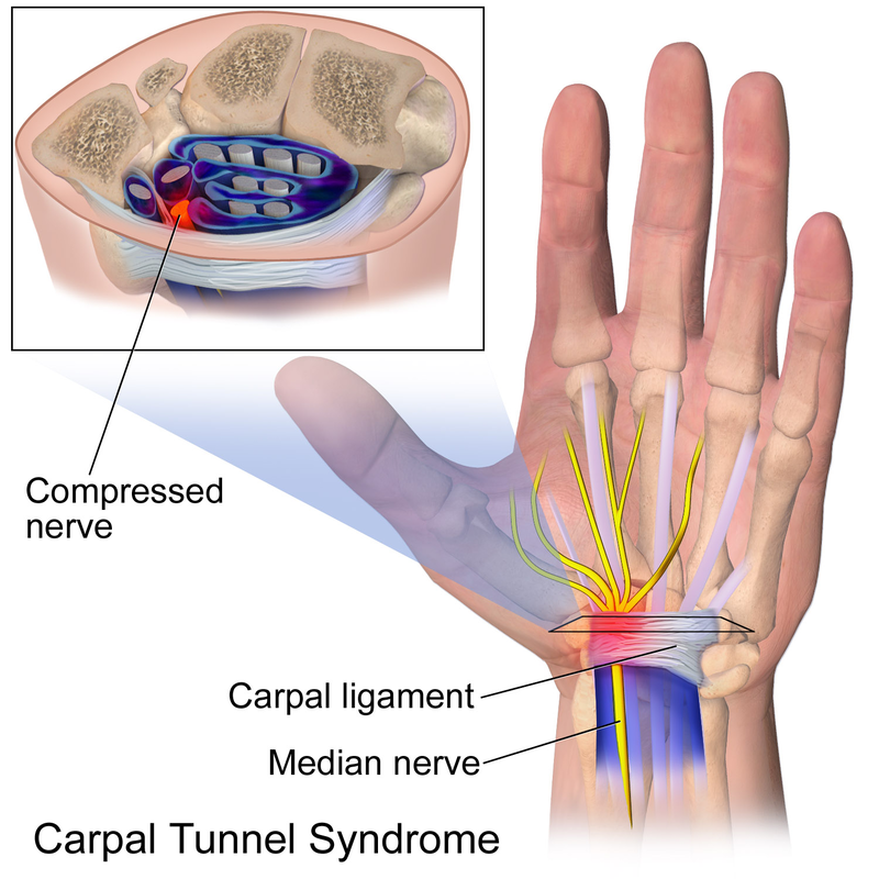 800px-Carpal_Tunnel_Syndrome