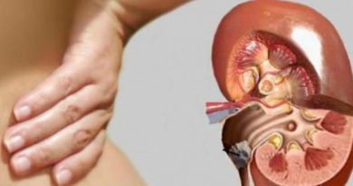 remove_kidney_stones_with_millet.thumb