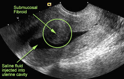 Sonohystogram long view of the uterus