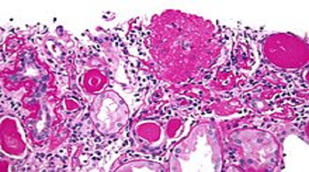 220px-Collapsing_glomerulopathy_-_very_high_mag