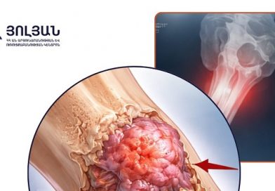 Յուինգի սարկոման ոսկրային չարորակ ուռուցքի տեսակ է, որի վաղ հայտնաբերումը խիստ կարևոր է