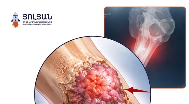 Յուինգի սարկոման ոսկրային չարորակ ուռուցքի տեսակ է, որի վաղ հայտնաբերումը խիստ կարևոր է