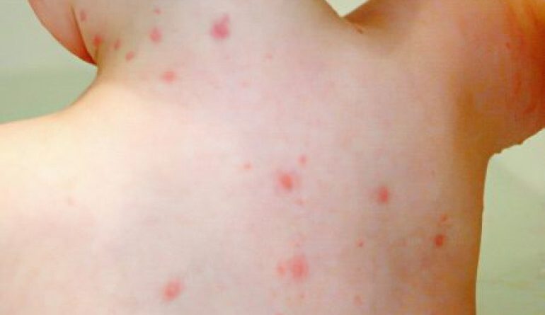 Հայաստանում ջրծաղիկով հիվանդացությունը նվազման միտում ունի․ մասնագետը ներկայացրել է պատճառները